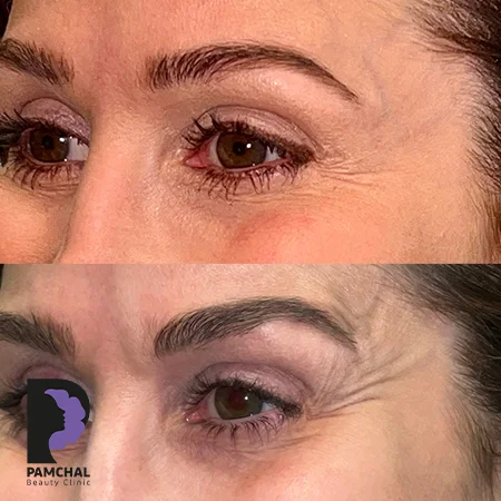 Botulinum toxin results before and after example 13 in Tehran