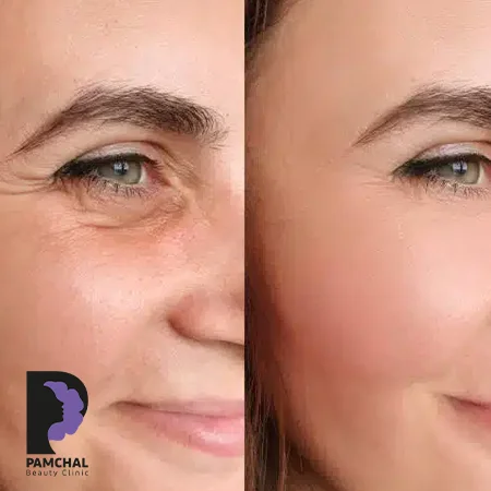 Botulinum toxin results before and after example 14 in Tehran