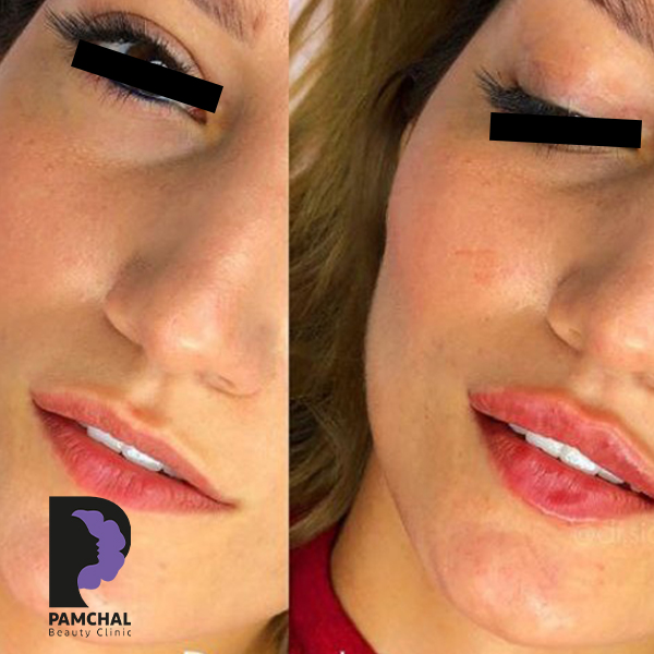 Lip filler results before and after example 5 in Tehran