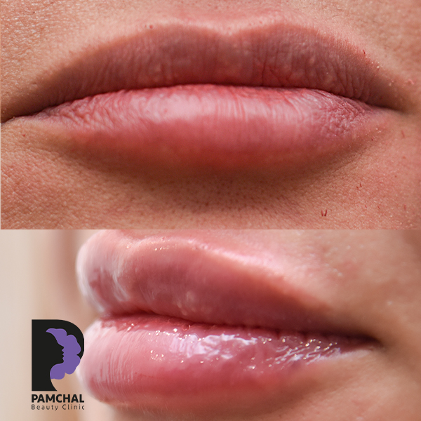Lip filler results before and after example 8 in Tehran