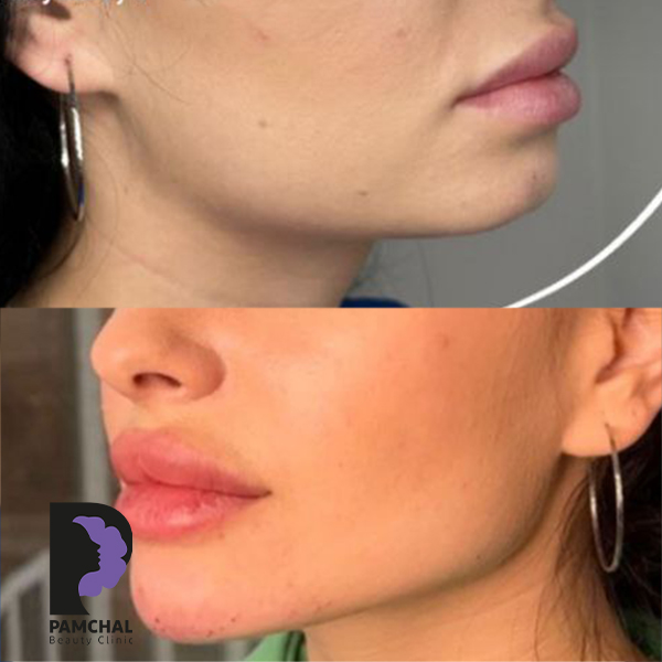 Cheeks, midface and full-face balancing before and after example 1 in Tehran