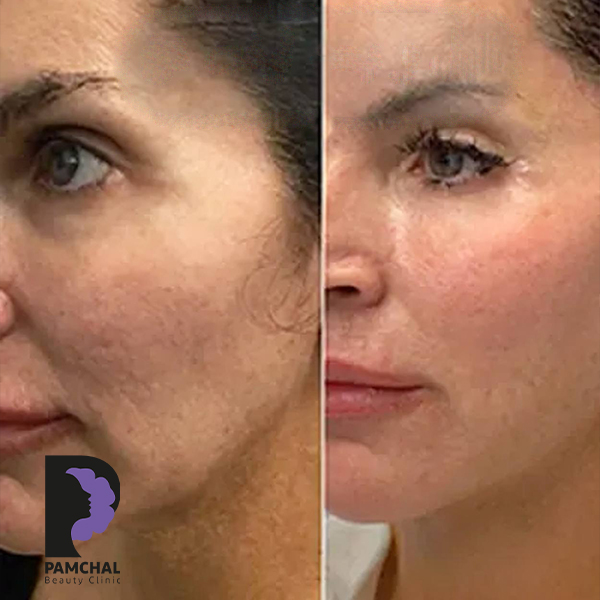 Cheeks, midface and full-face balancing before and after example 4 in Tehran