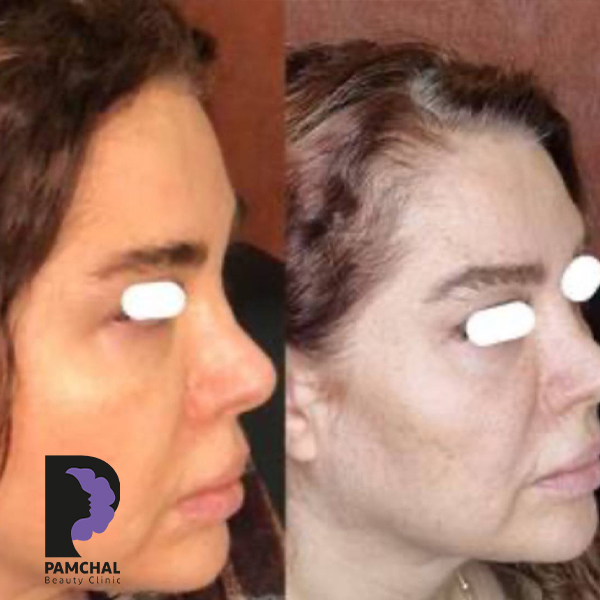 Cheeks, midface and full-face balancing before and after example 6 in Tehran