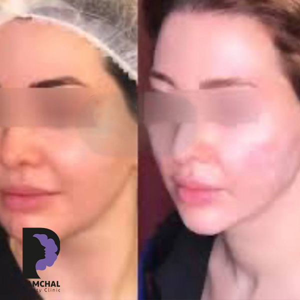 Cheeks, midface and full-face balancing before and after example 7 in Tehran