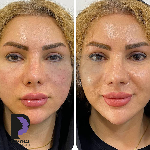 Cheeks, midface and full-face balancing before and after example 8 in Tehran