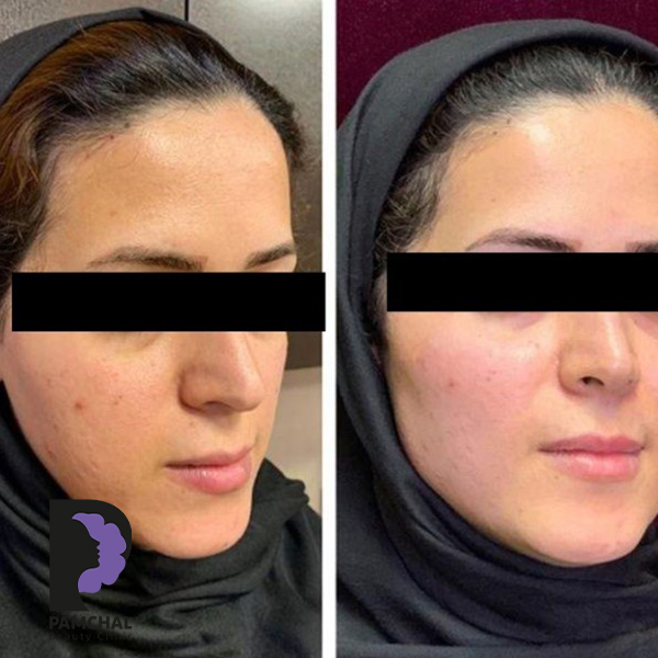Cheeks, midface and full-face balancing before and after example 9 in Tehran