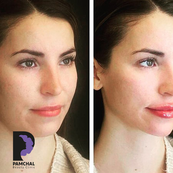 Cheeks, midface and full-face balancing before and after example 10 in Tehran
