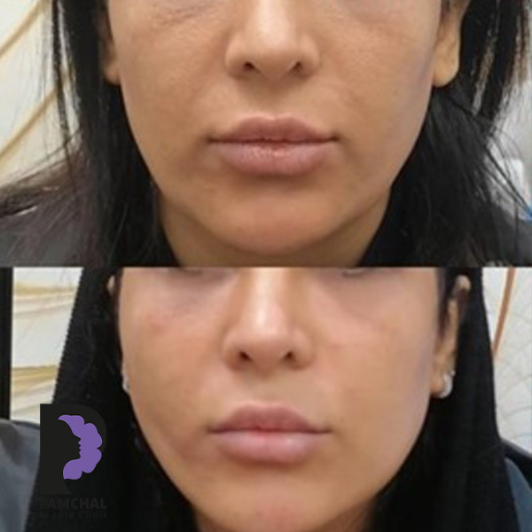 Cheeks, midface and full-face balancing before and after example 11 in Tehran