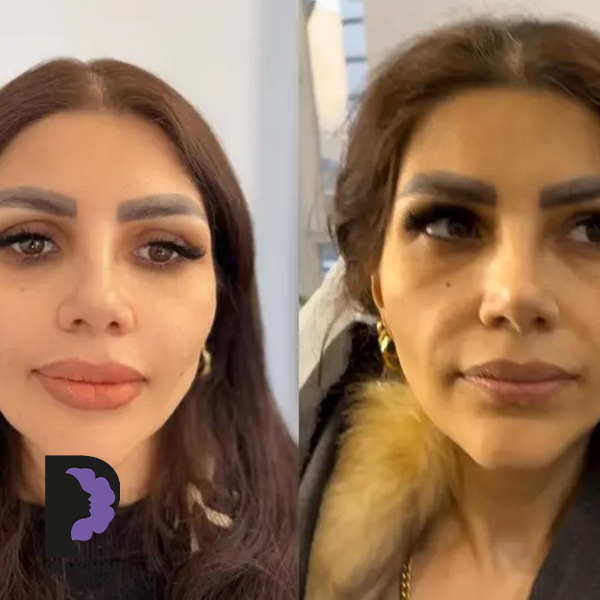 Cheeks, midface and full-face balancing before and after example 12 in Tehran