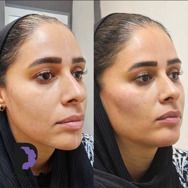 Cheeks, midface and full-face balancing before and after example 13 in Tehran