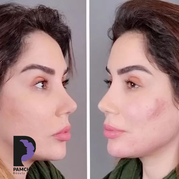 Cheeks, midface and full-face balancing before and after example 14 in Tehran