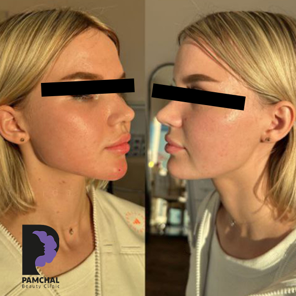 Jawline, chin and profile contouring before and after example 3 in Tehran