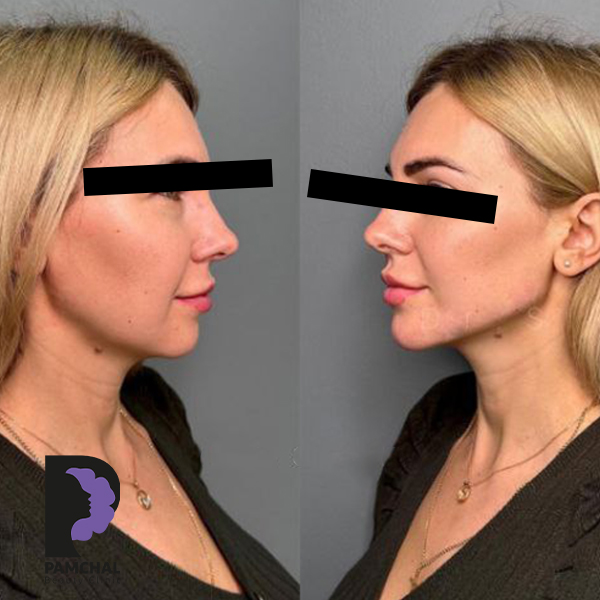 Jawline, chin and profile contouring before and after example 4 in Tehran
