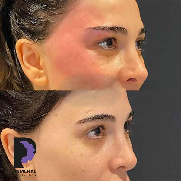 Jawline, chin and profile contouring before and after example 6 in Tehran