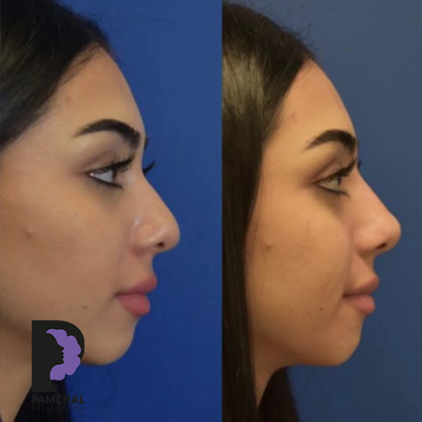 Jawline, chin and profile contouring before and after example 8 in Tehran