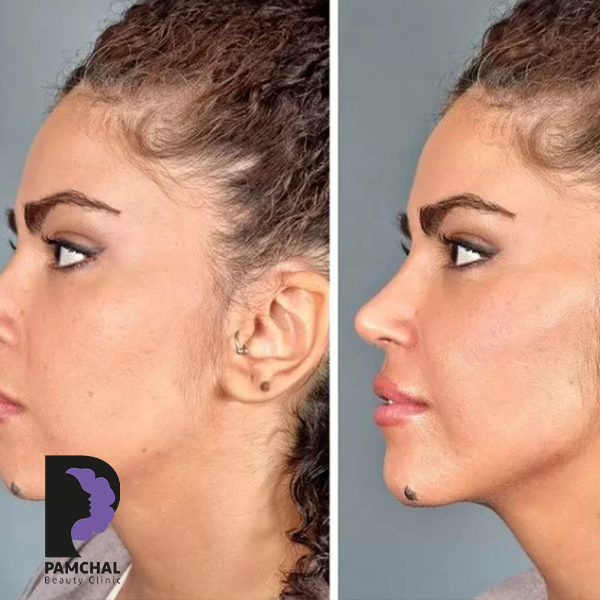 Jawline, chin and profile contouring before and after example 10 in Tehran