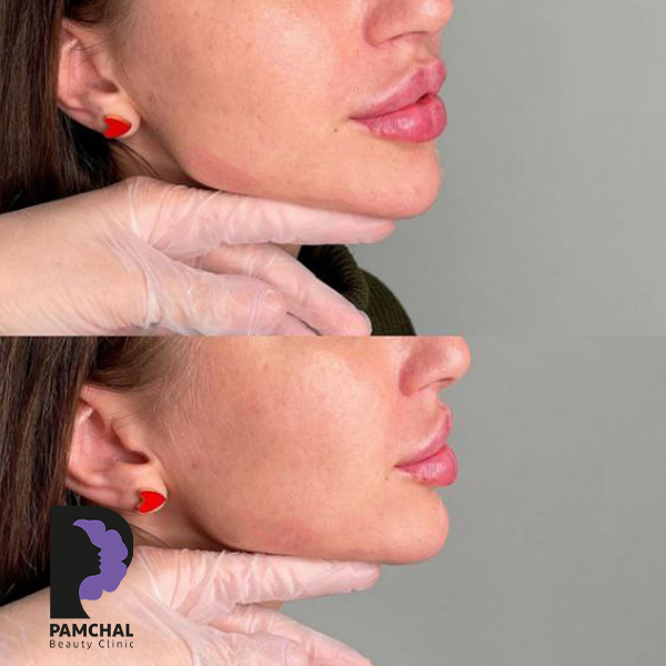 Jawline, chin and profile contouring before and after example 11 in Tehran