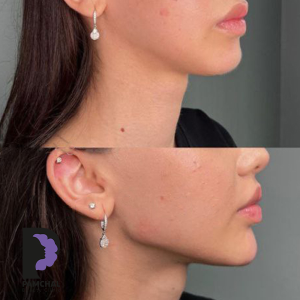 Jawline, chin and profile contouring before and after example 12 in Tehran