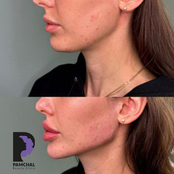 Jawline, chin and profile contouring before and after example 14 in Tehran