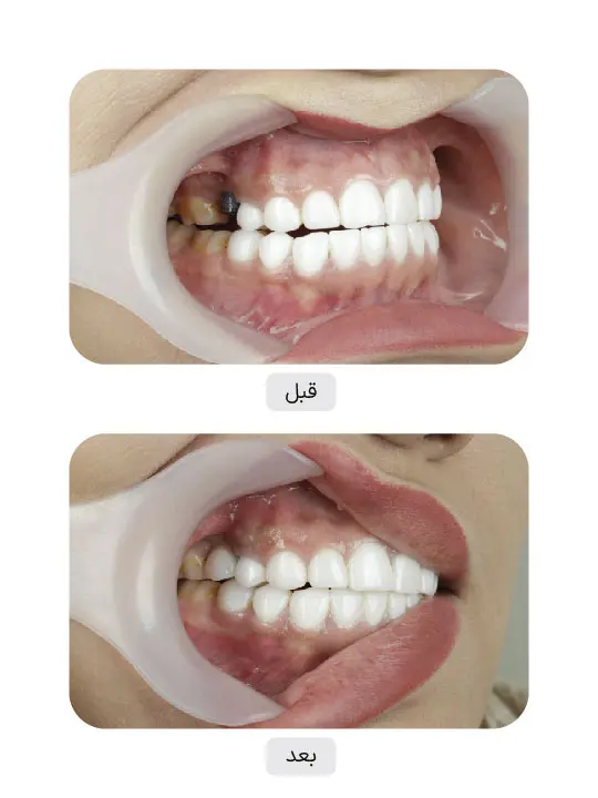 Before and after dental implant treatment, case 2, Iran Implant clinic in Tehran