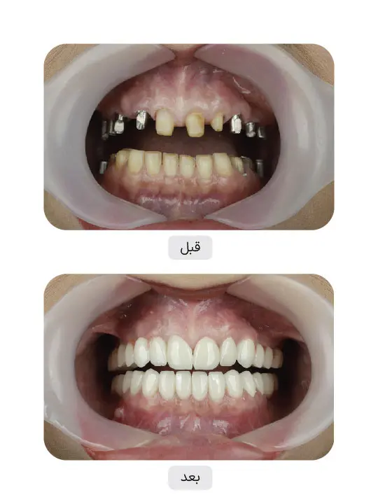Before and after dental implant treatment, case 4, Iran Implant clinic in Tehran