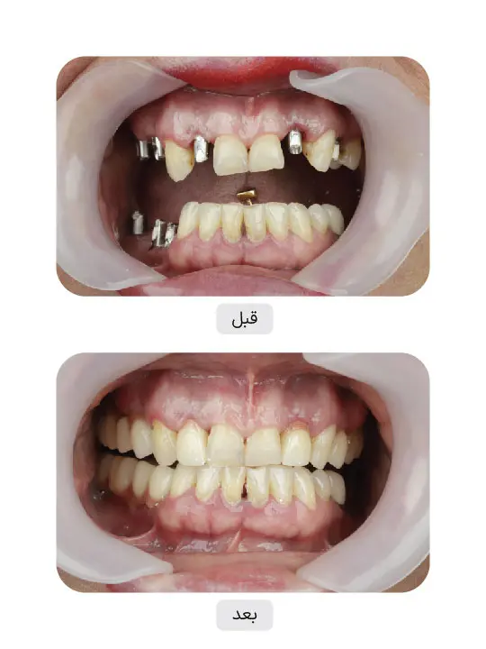 Before and after dental implant treatment, case 5, Iran Implant clinic in Tehran