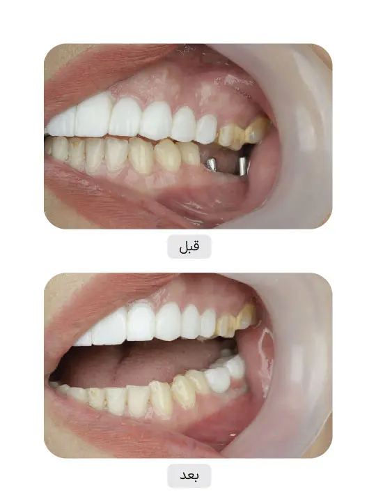 Before and after dental implant treatment, case 6, Iran Implant clinic in Tehran