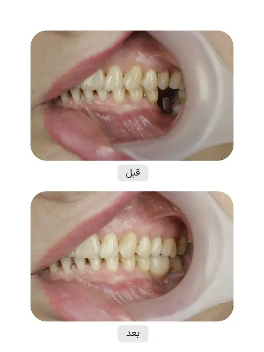 Before and after dental implant treatment, case 9, Iran Implant clinic in Tehran
