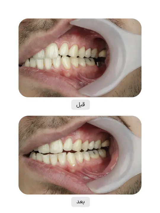 Before and after dental implant treatment, case 11, Iran Implant clinic in Tehran