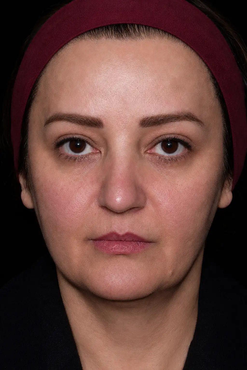 Eyelid surgery, frontal comparison after treatment, Dr Arash Najaf Beigi