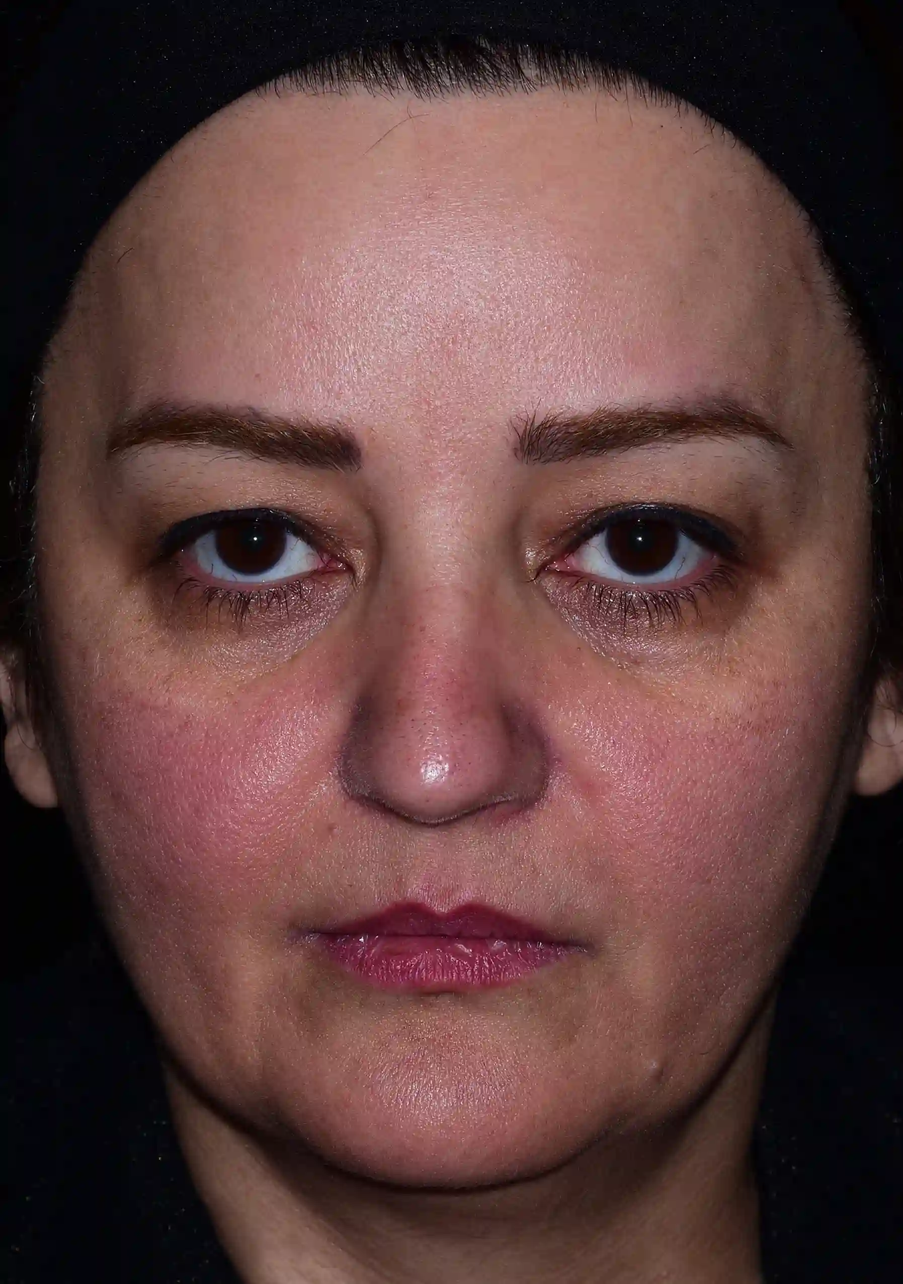 Eyelid surgery, frontal comparison before treatment, Dr Arash Najaf Beigi