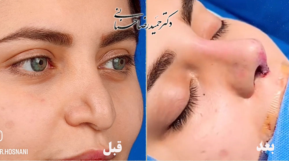 Revision rhinoplasty before and after, oblique view, published by Dr Hosnani