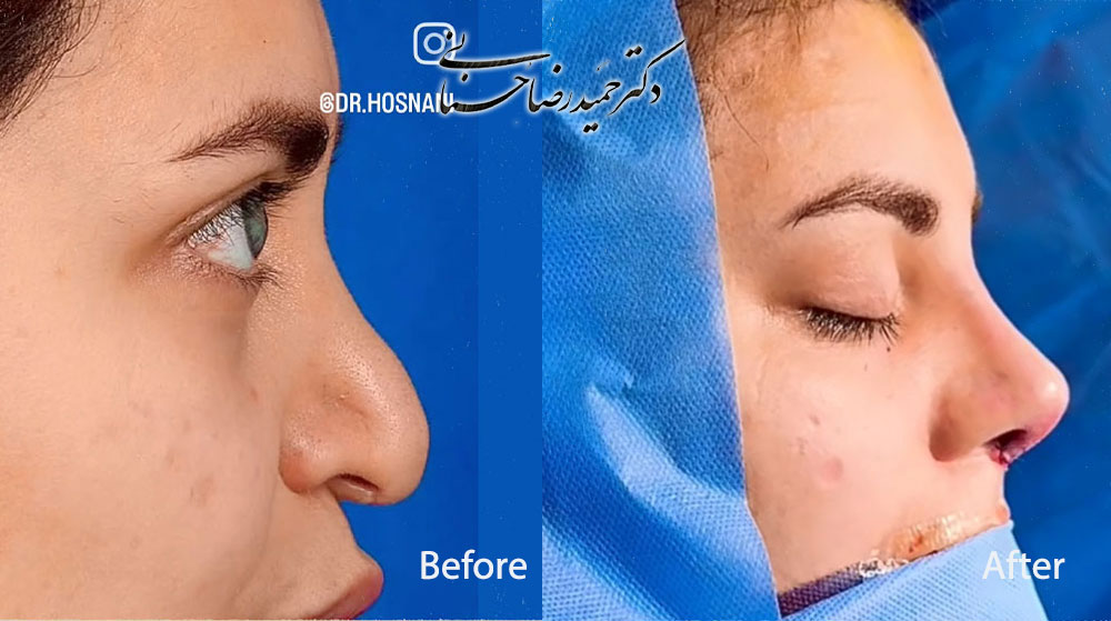 Revision rhinoplasty before and after, profile view, published by Dr Hosnani
