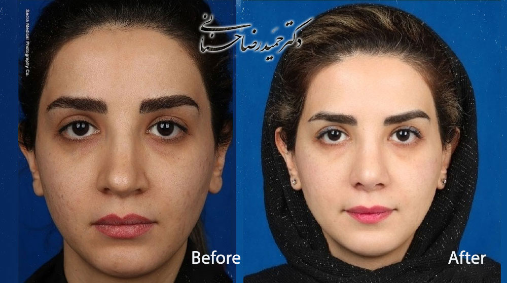 Revision nose surgery before and after, front view, published by Dr Hosnani