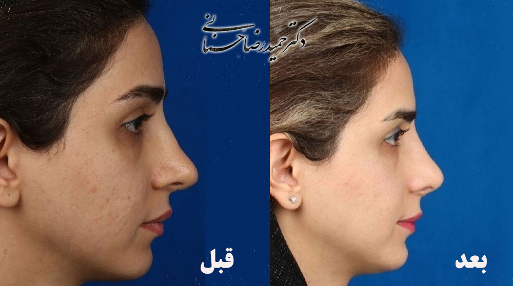 Revision nose surgery before and after, profile view, published by Dr Hosnani