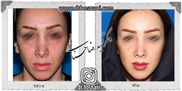 Revision rhinoplasty before and after, front view, published by Dr Hamidreza Hosnani