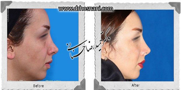 Revision rhinoplasty before and after, side view, published by Dr Hamidreza Hosnani