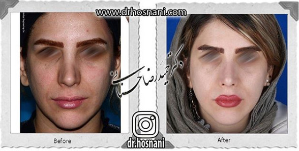 Secondary nose surgery before and after, front view, published by Dr Hosnani