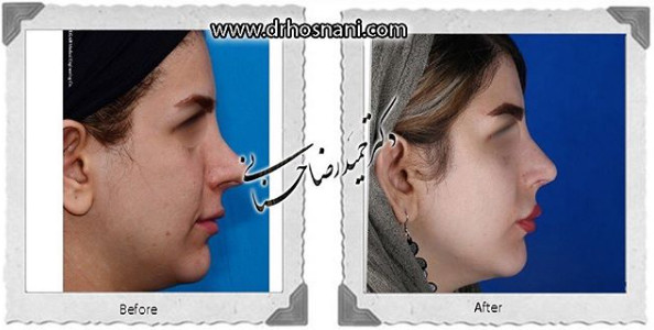 Secondary nose surgery before and after, profile view, published by Dr Hosnani