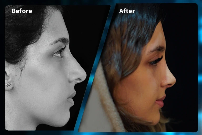 Rhinoplasty before and after comparison, example 1, published by Dr Armin Akbari