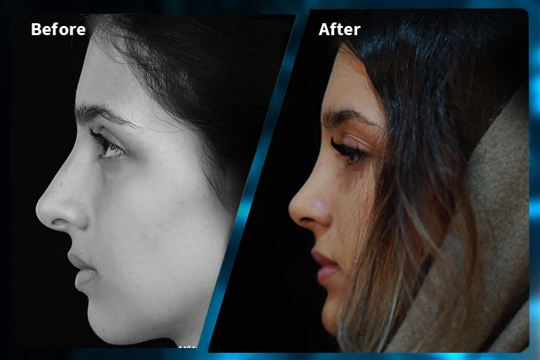 Rhinoplasty before and after comparison, example 2, published by Dr Armin Akbari