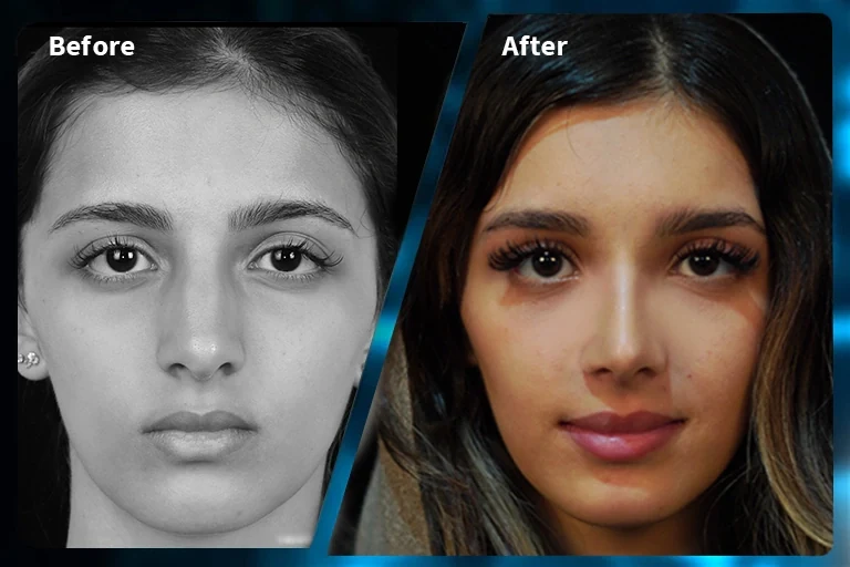 Rhinoplasty before and after comparison, example 3, published by Dr Armin Akbari