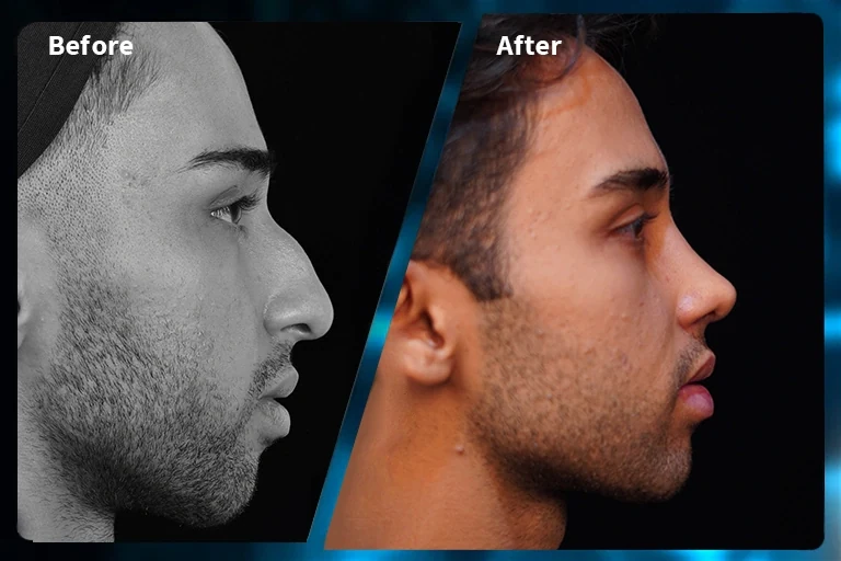 Rhinoplasty before and after comparison, example 4, published by Dr Armin Akbari