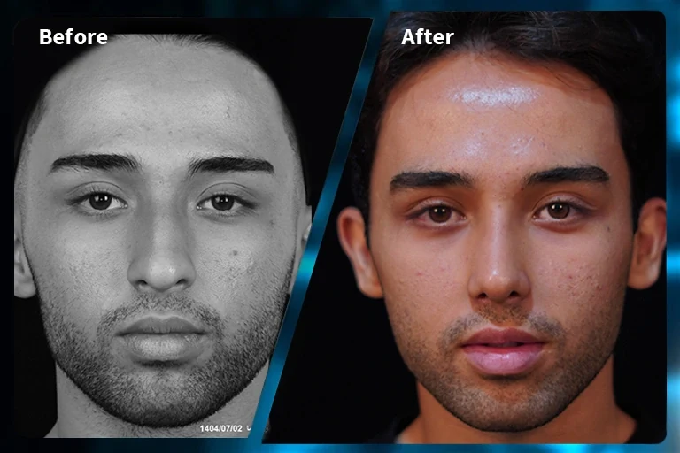 Rhinoplasty before and after comparison, example 5, published by Dr Armin Akbari