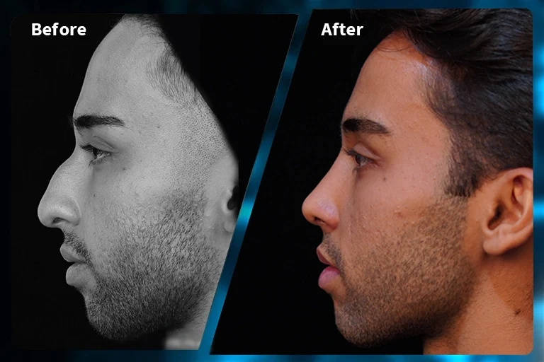 Rhinoplasty before and after comparison, example 6, published by Dr Armin Akbari