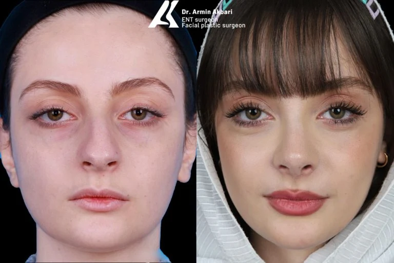 Rhinoplasty before and after comparison, example 7, published by Dr Armin Akbari