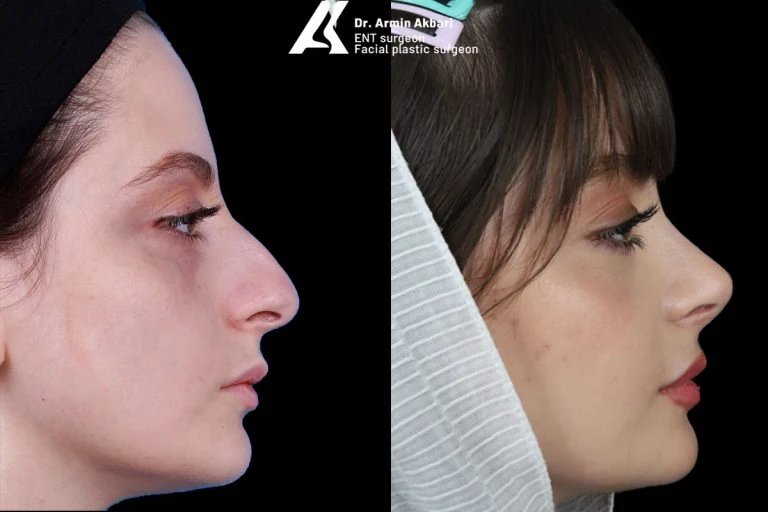 Rhinoplasty before and after comparison, example 8, published by Dr Armin Akbari
