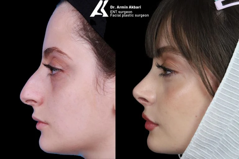 Rhinoplasty before and after comparison, example 9, published by Dr Armin Akbari