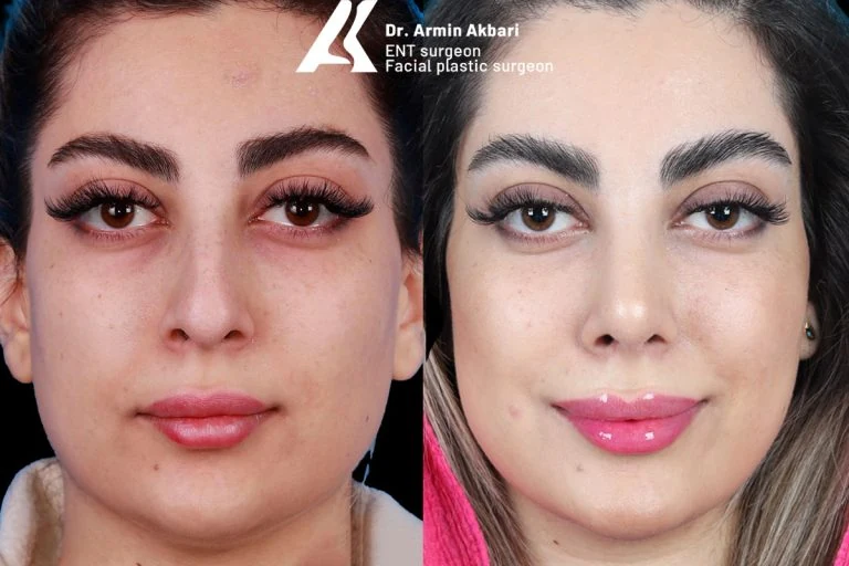 Rhinoplasty before and after comparison, example 10, published by Dr Armin Akbari
