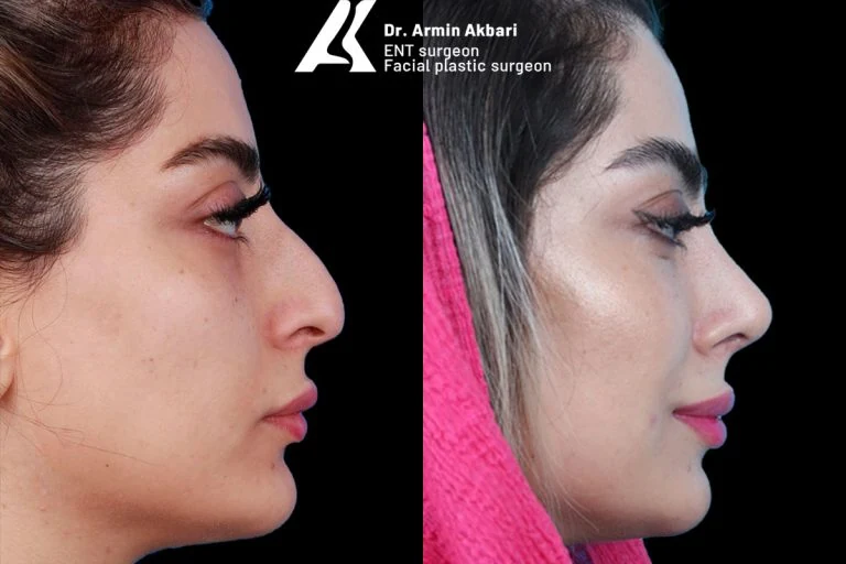 Rhinoplasty before and after comparison, example 11, published by Dr Armin Akbari